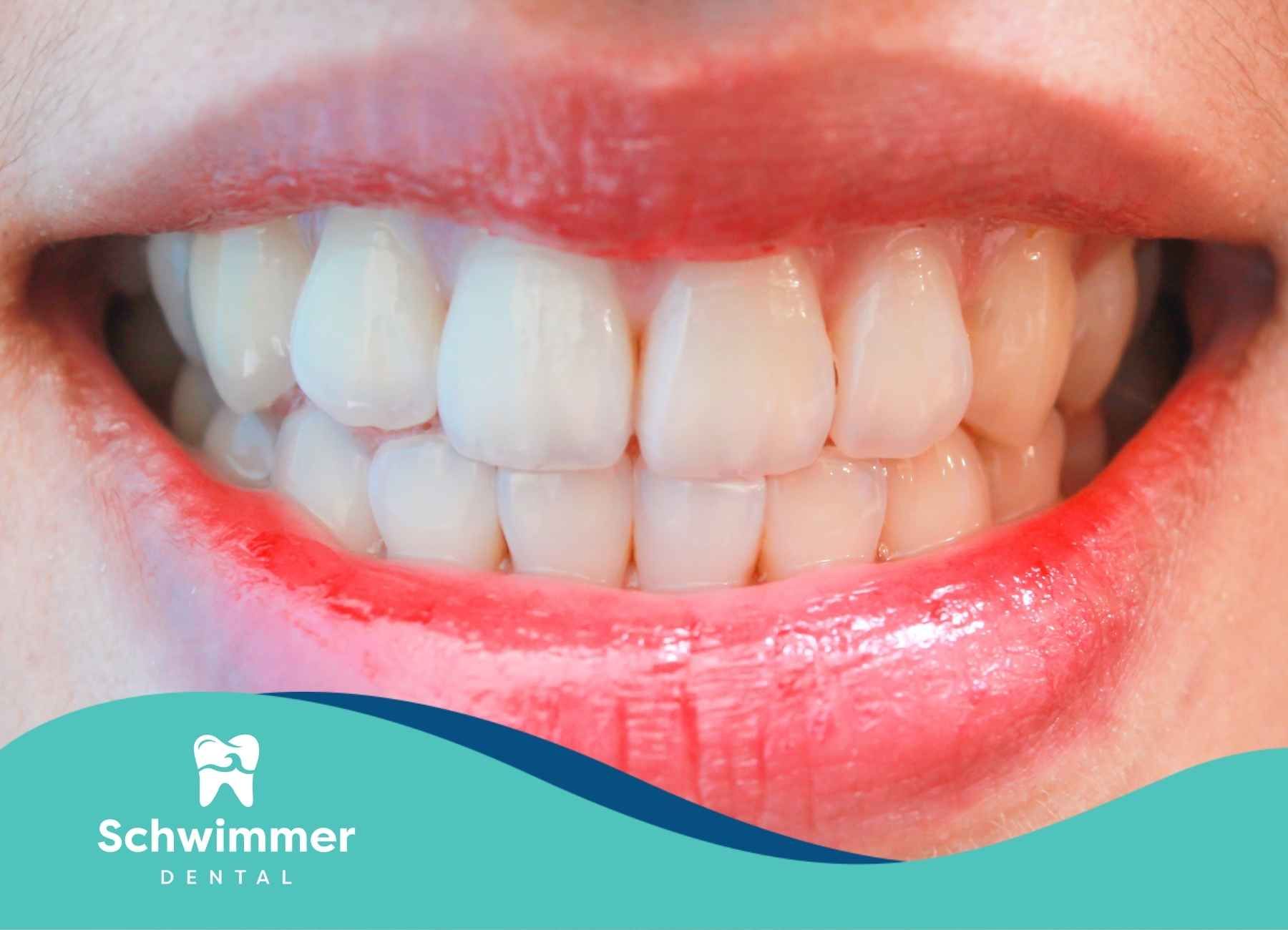 Close-up of a smiling mouth with translucent teeth and red lipstick.