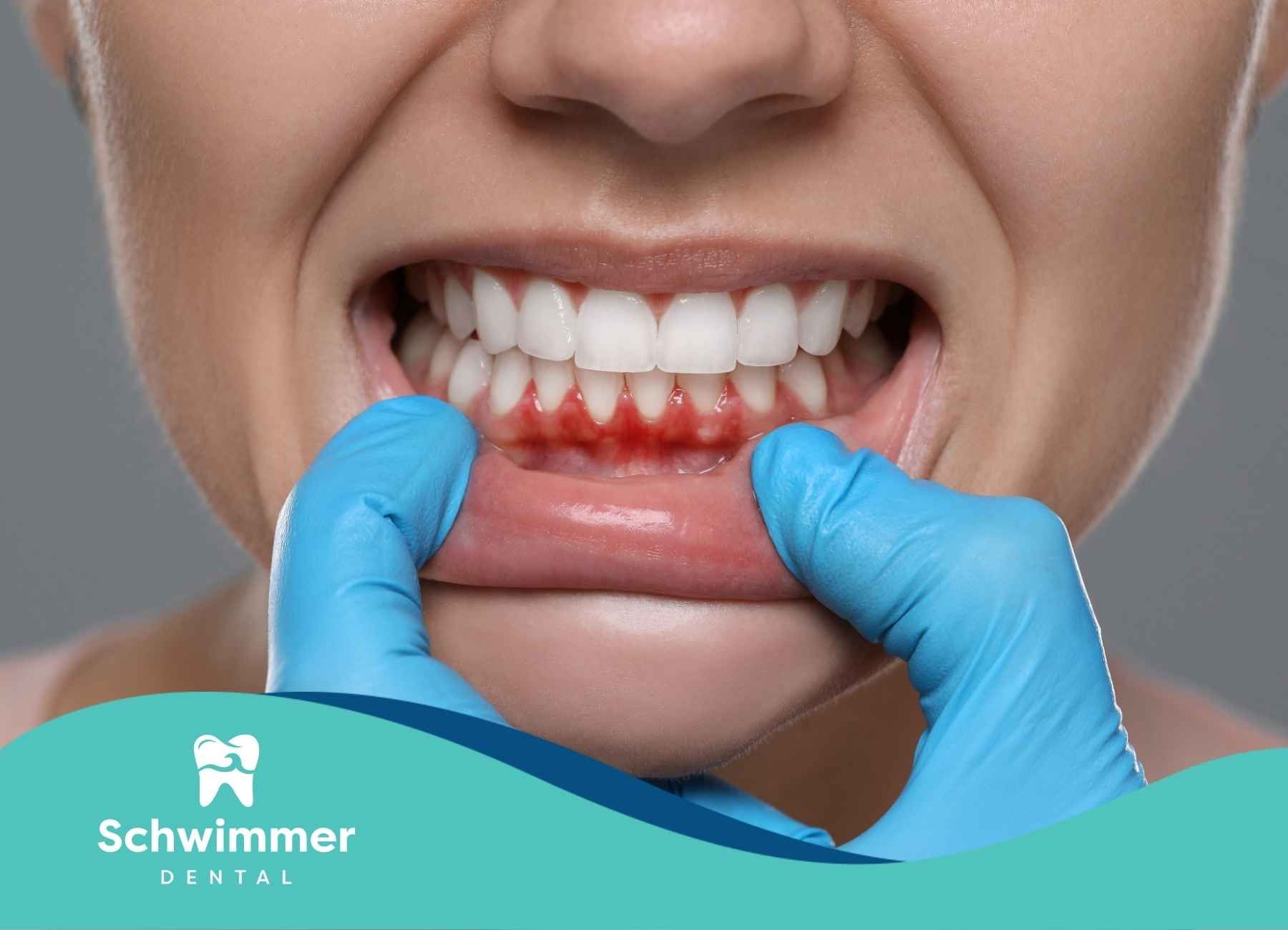 Woman's gums are red and inflamed. A gloved hand is lifting the lip.