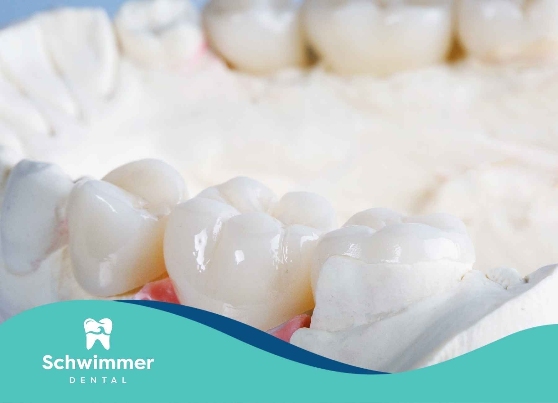 Dental bridge model with pink gum line, white teeth.