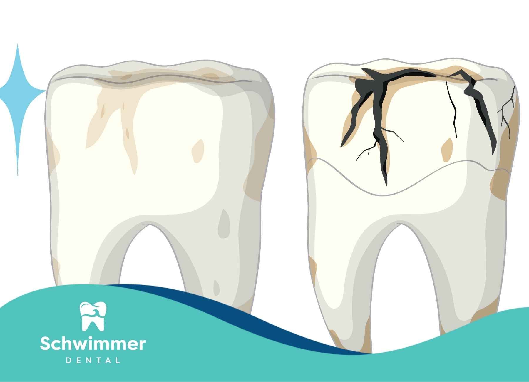 Teeth showing stages of decay: clean, stained, and severely decayed, with a star.