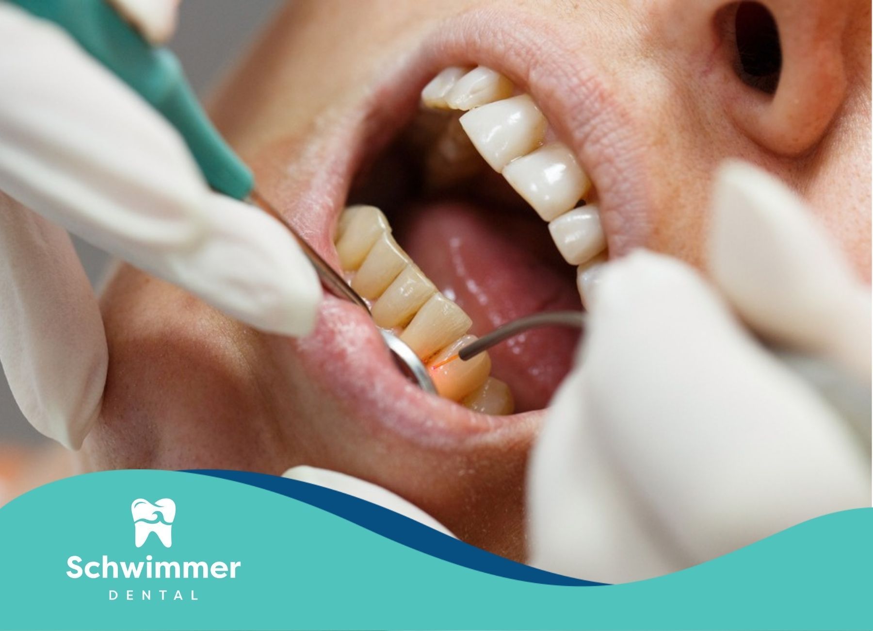 Close-up of laser dental treatment being performed on lower teeth at a dental clinic in New Jersey.