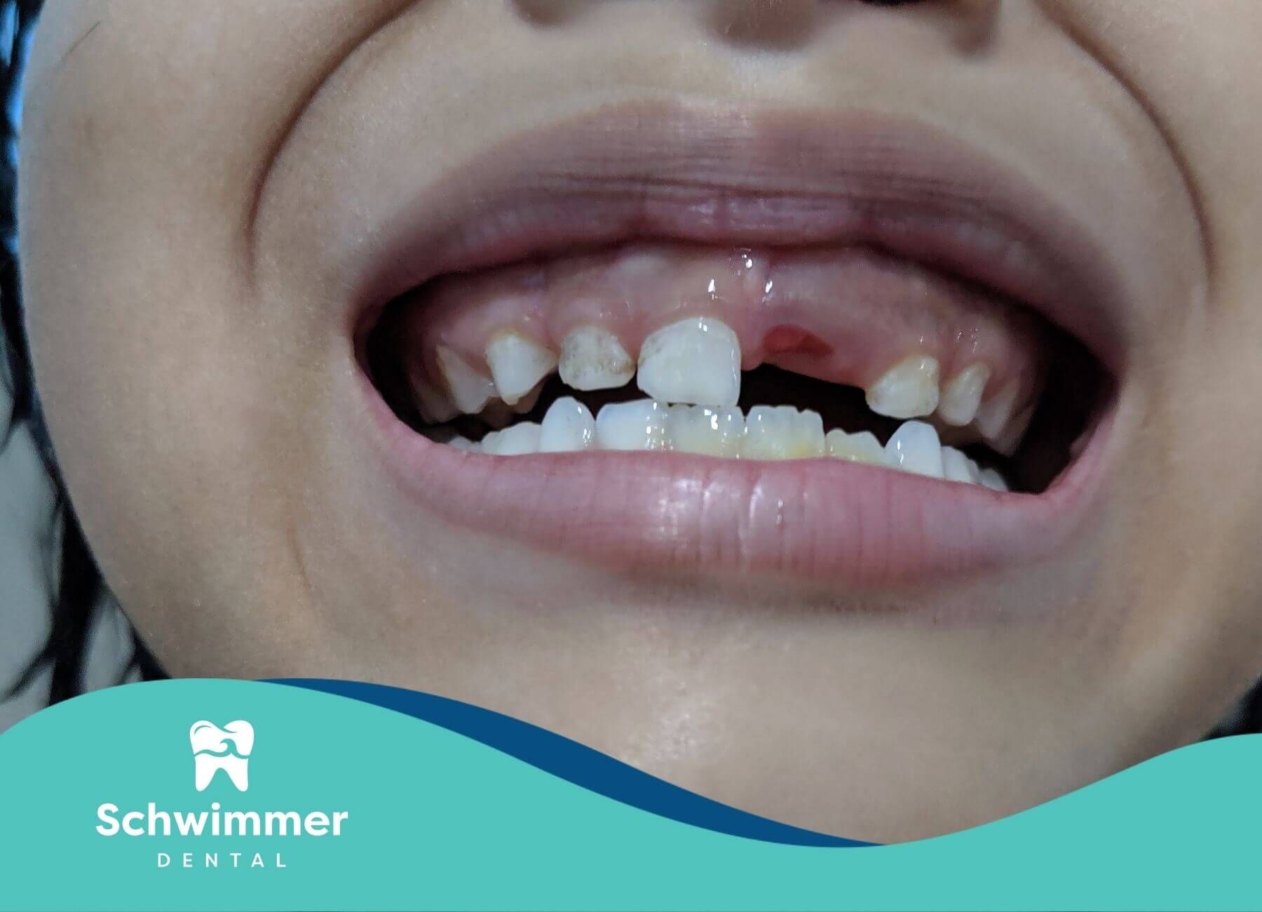 Close-up of a child’s mouth showing uneven baby teeth, highlighting common early dental development.