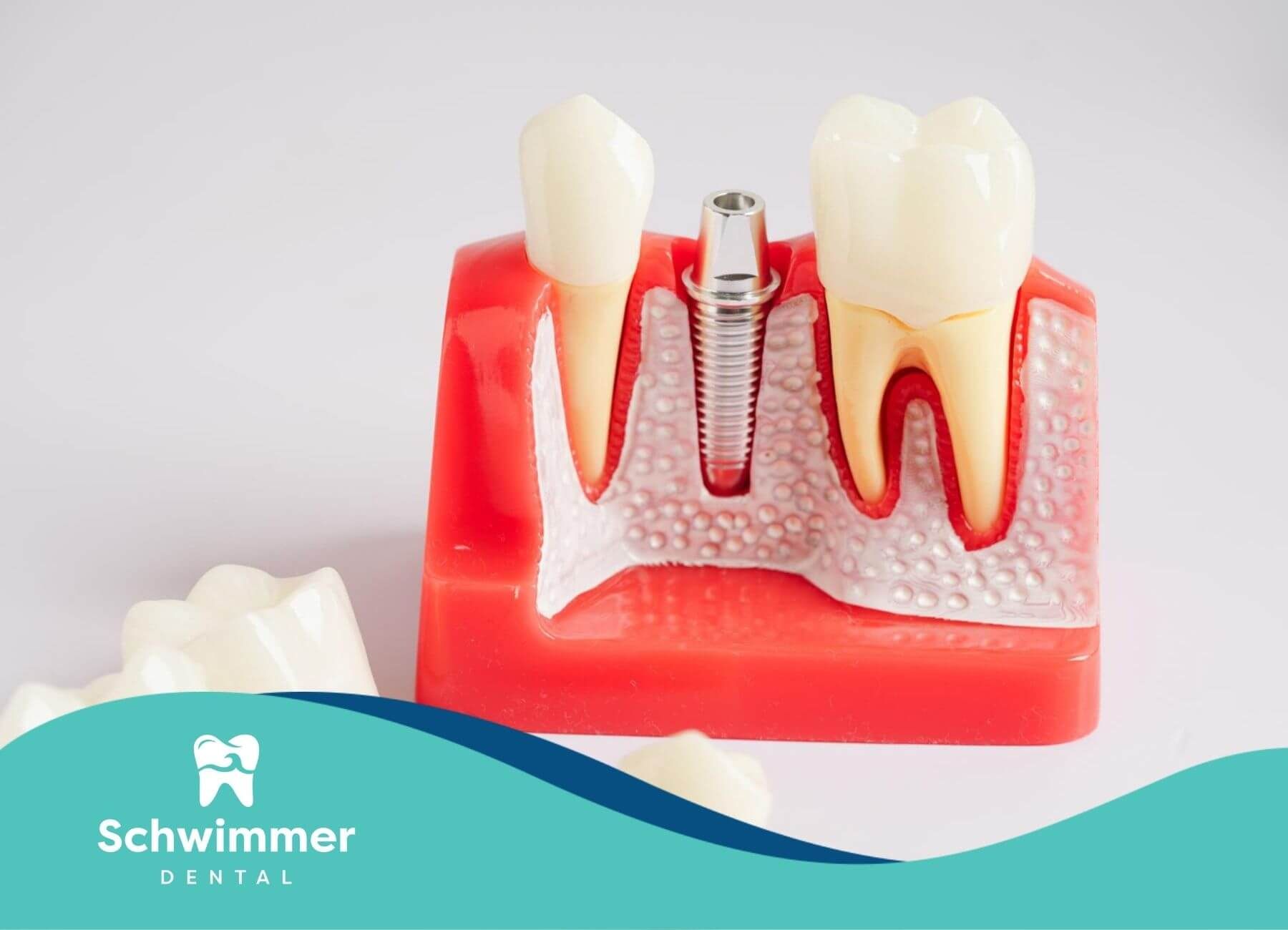 Dental model showing a tooth implant, with surrounding gums and teeth.