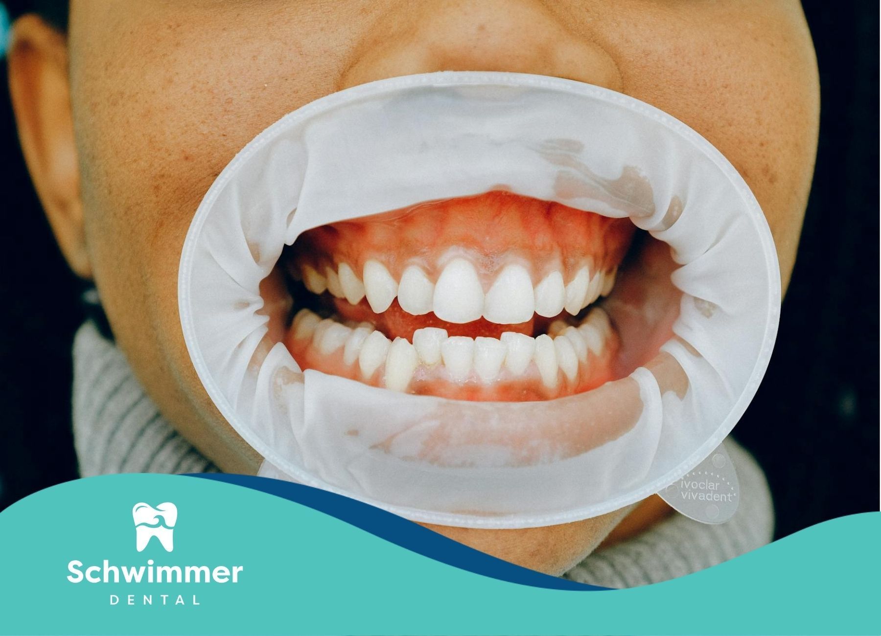 Mouth open with cheek retractor showing clean teeth at a dental appointment in Point Pleasant, NJ.