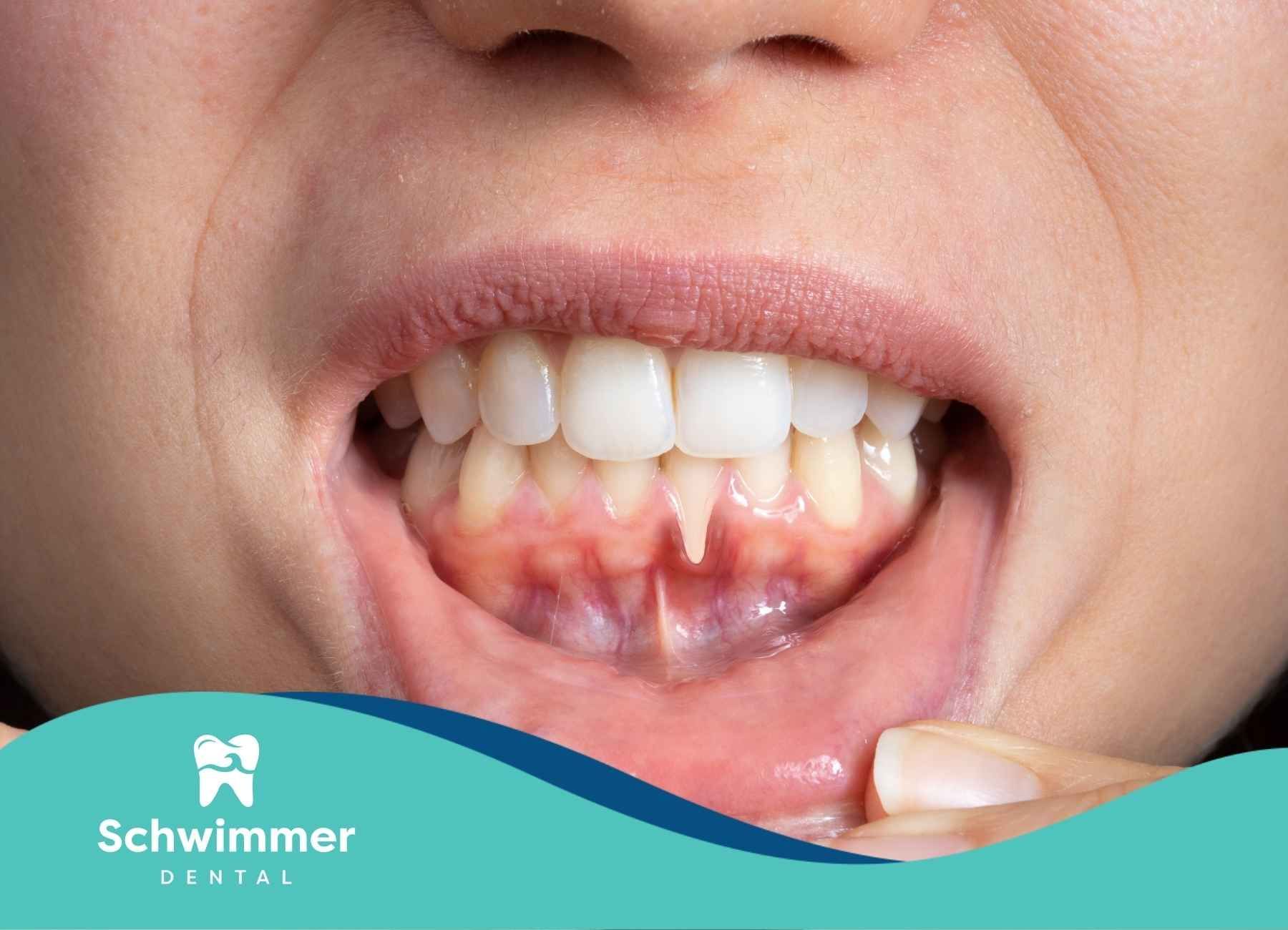 Close-up of open mouth showing gums. The gums are red and inflamed. White teeth are visible.