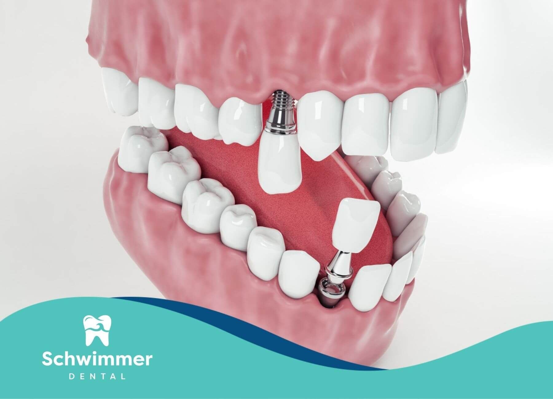 A model of a person's teeth with braces on them.