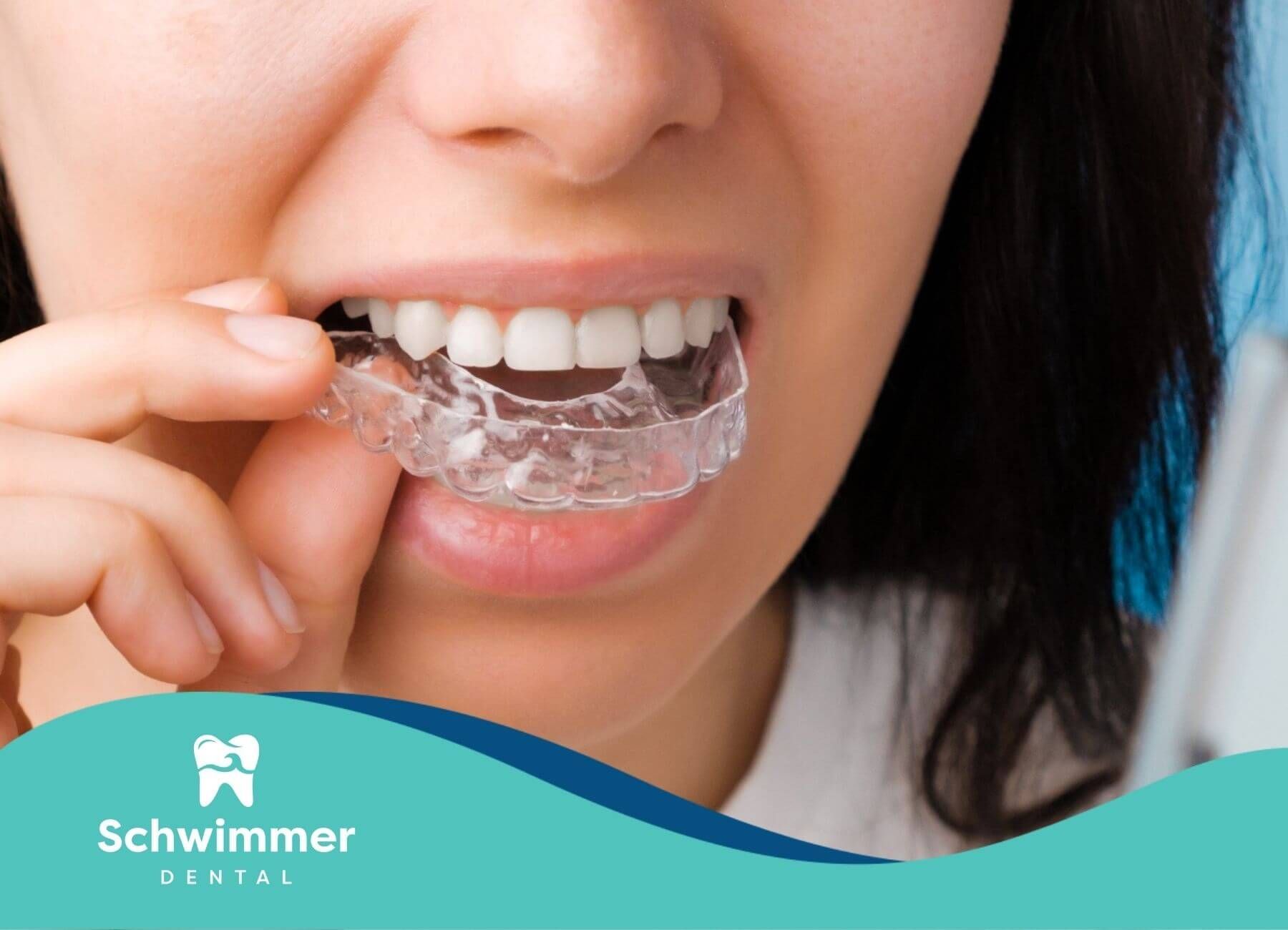 Person inserting a clear dental retainer on upper teeth.