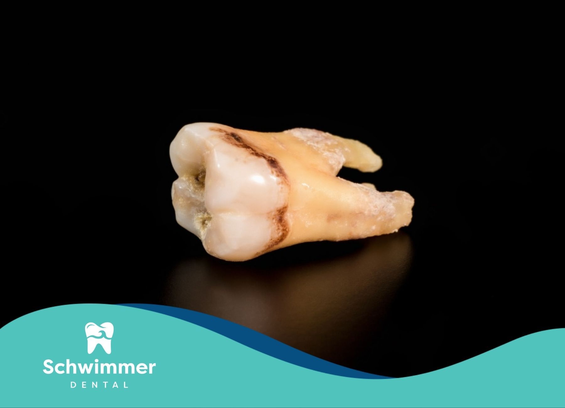 A decayed molar tooth on a black background after an extraction at a dental clinic in New Jersey.