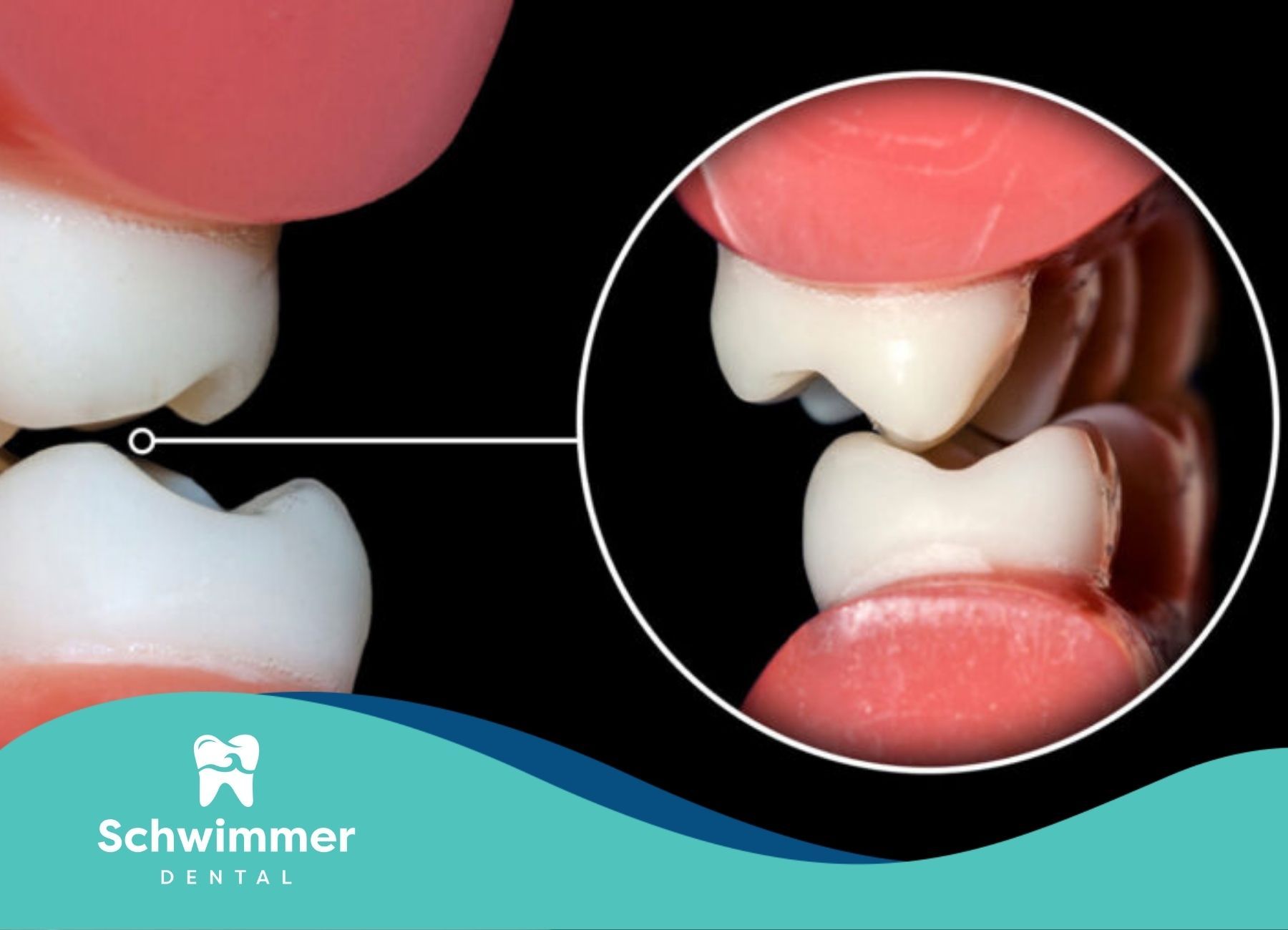 Close-up of dental implant failure with inset diagram during a check-up at a dental clinic in NJ.