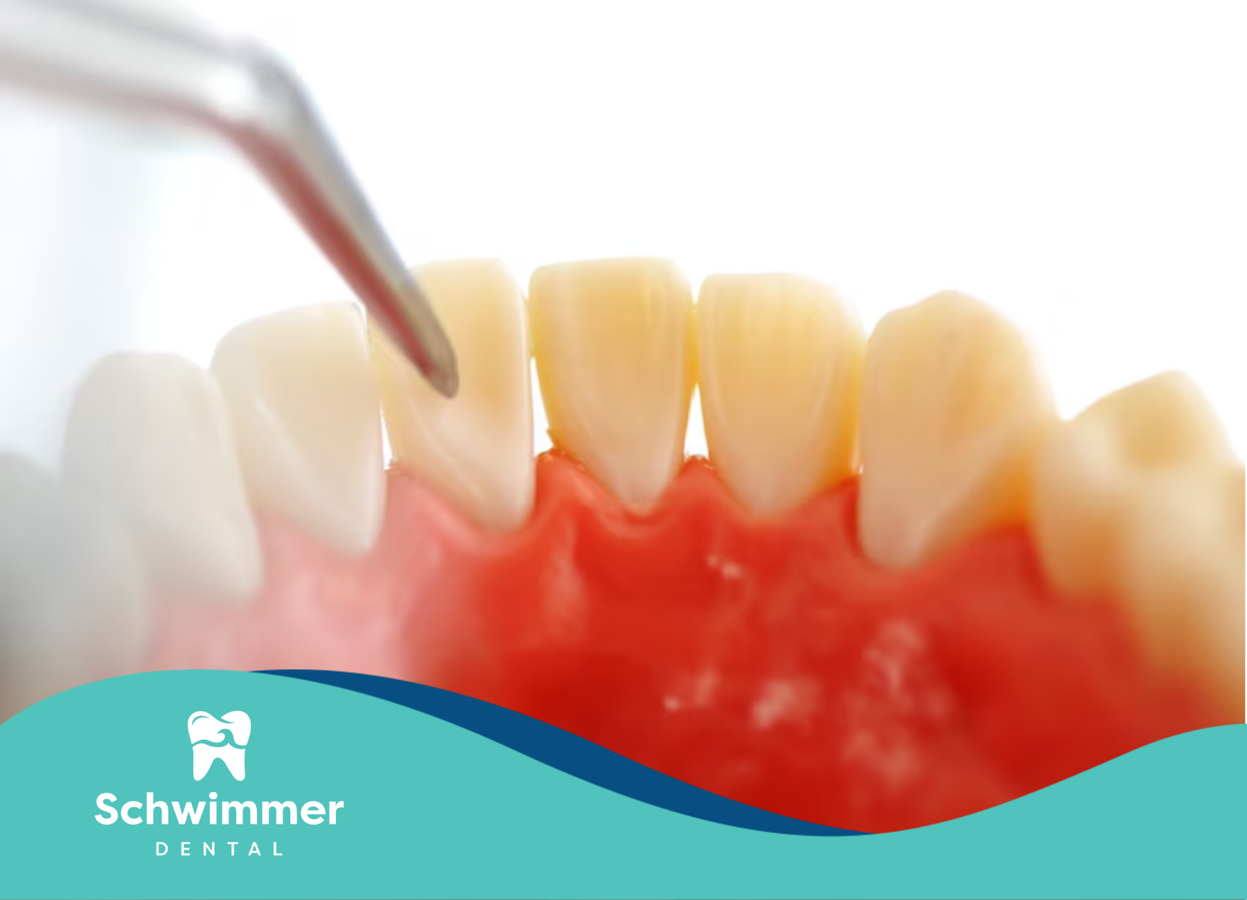 A close-up of a patient's teeth during dental scaling