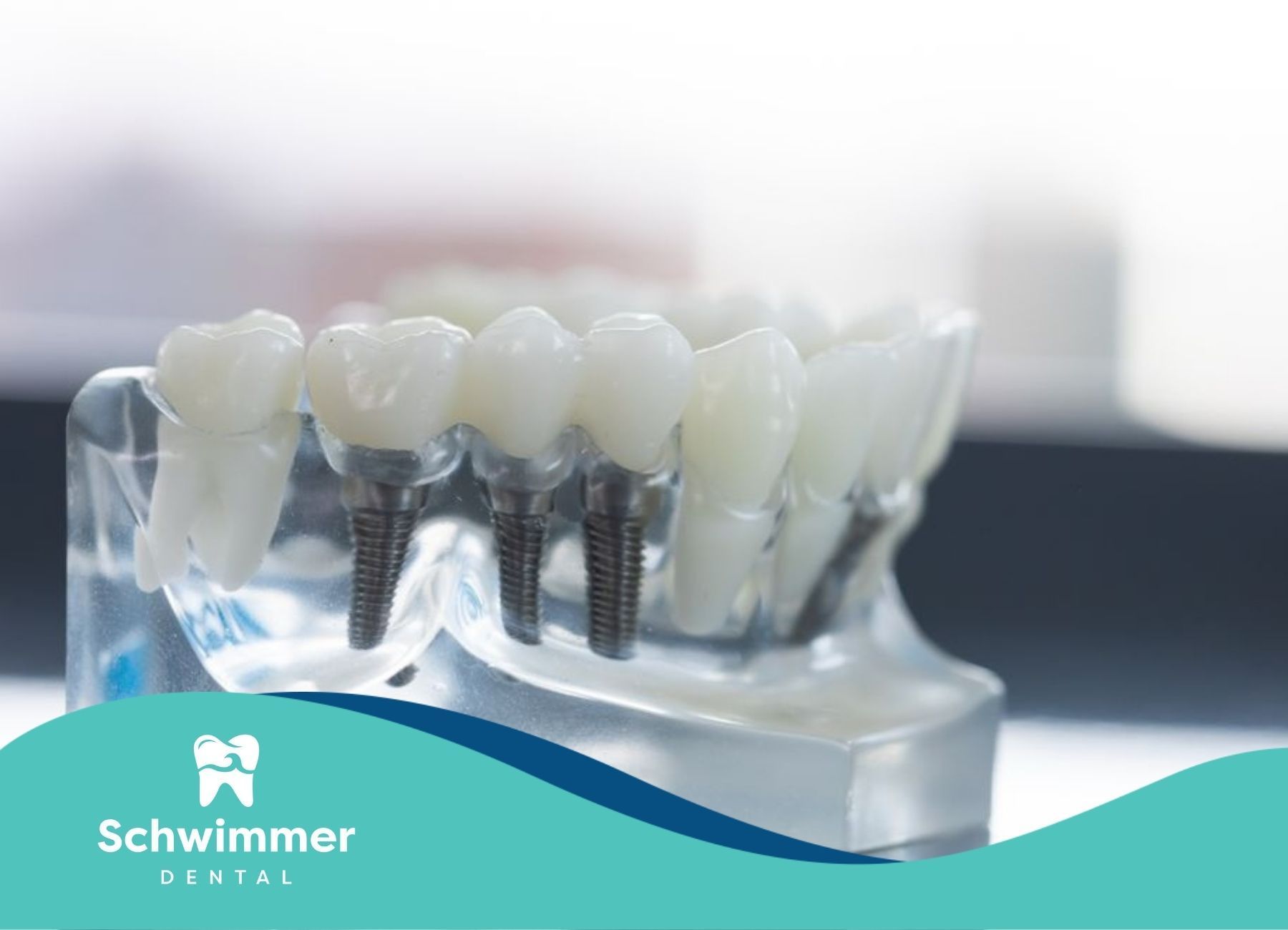 Model showing titanium dental implants and artificial teeth on transparent jaw base at clinic in NJ.