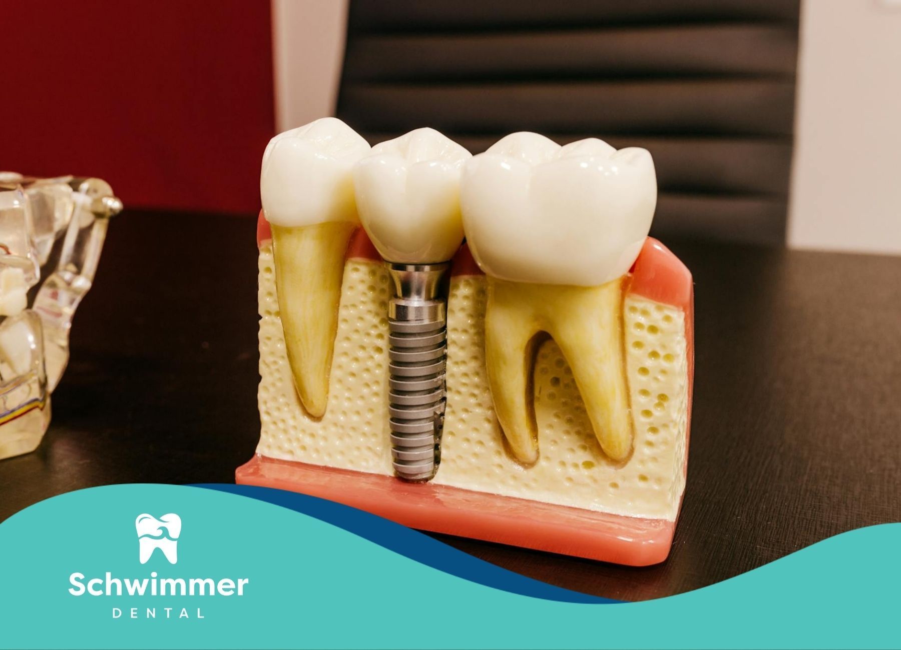 Dental implant model showing artificial tooth, gum structure, and tooth bone graft procedure in NJ.
