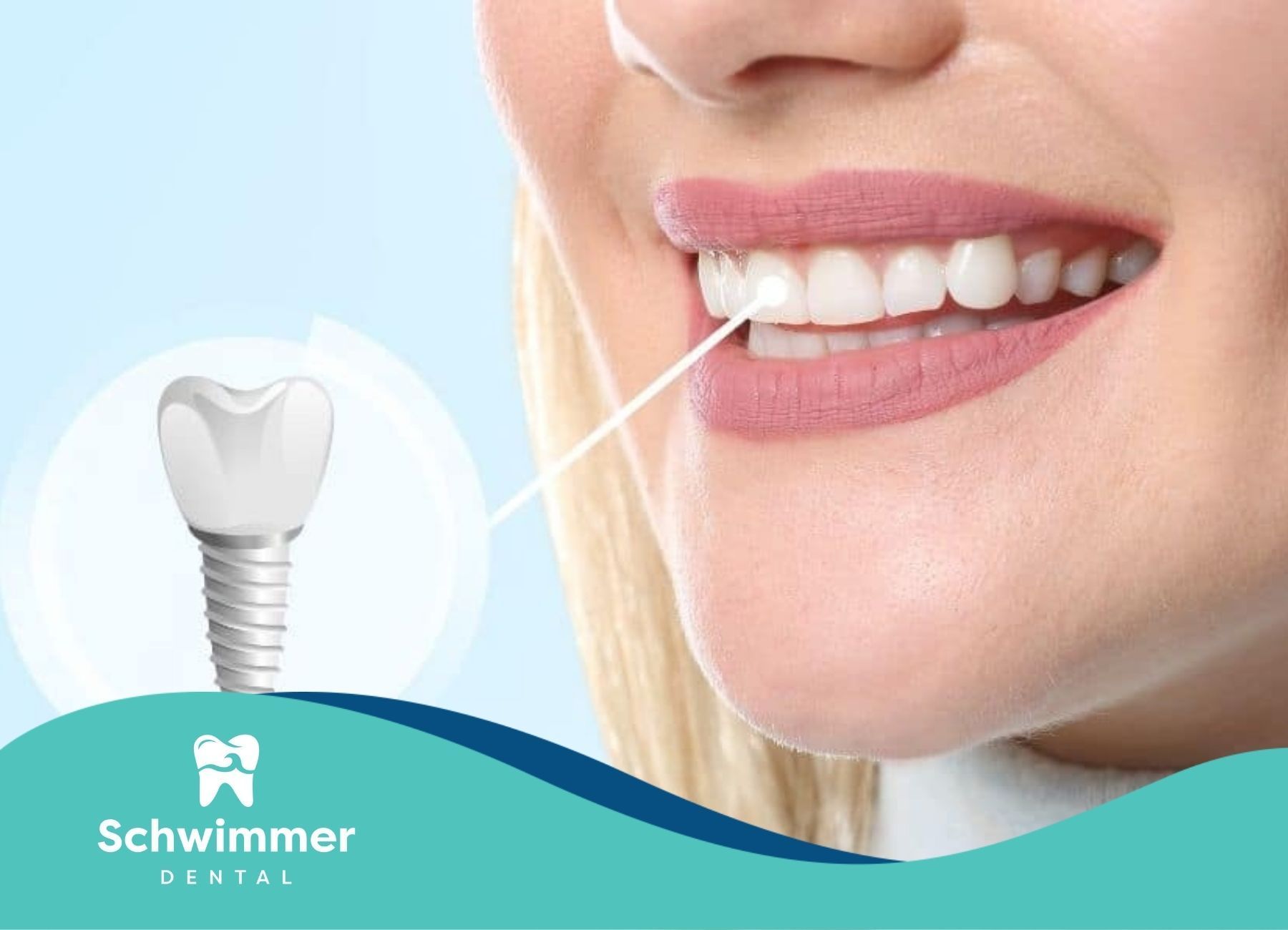 Close-up of a woman's bright smile with a dental implant illustration after dental check-up in NJ.
