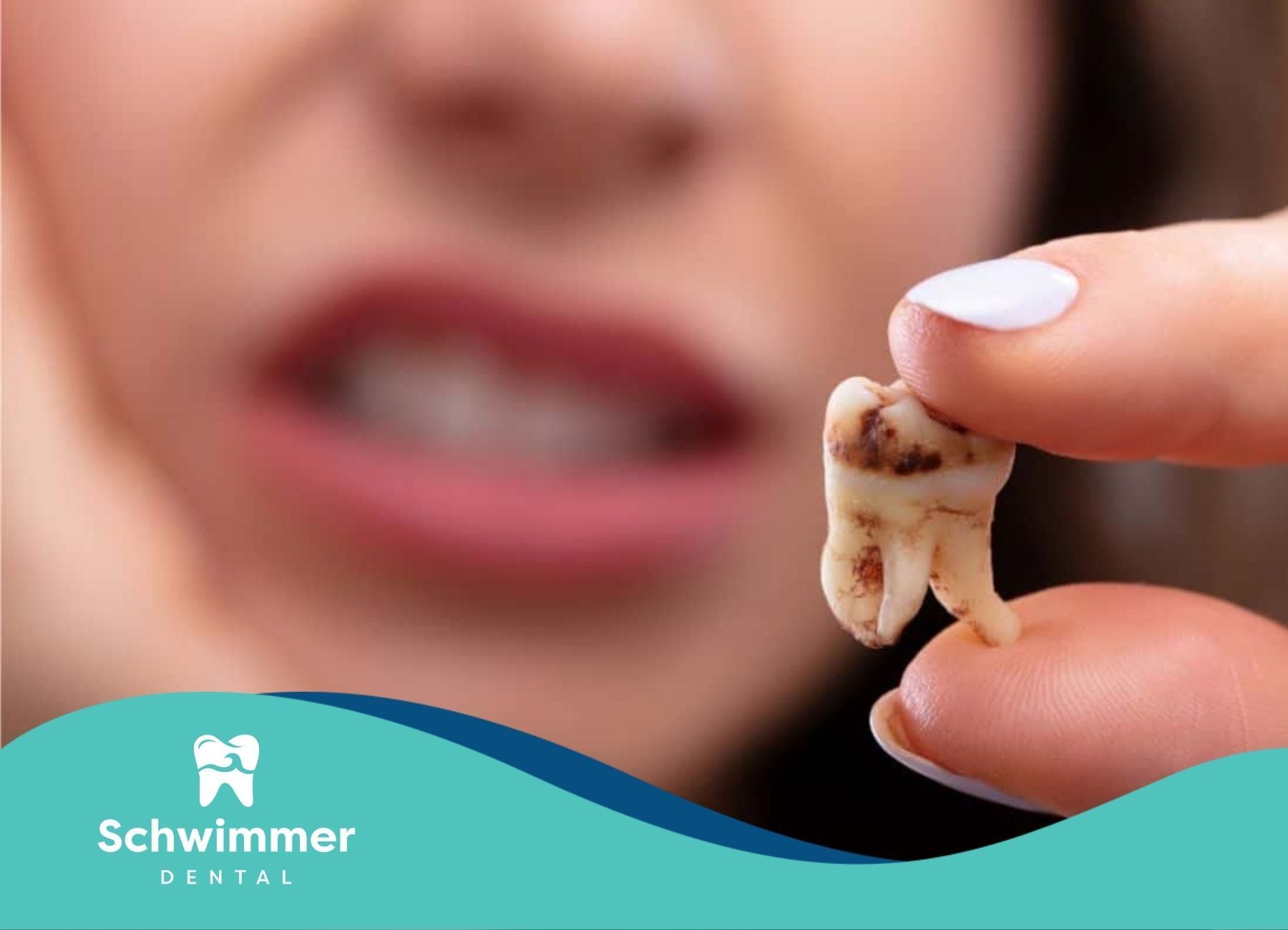 Person holding a decayed wisdom tooth with dark spots, searching for best dental treatments in NJ.
