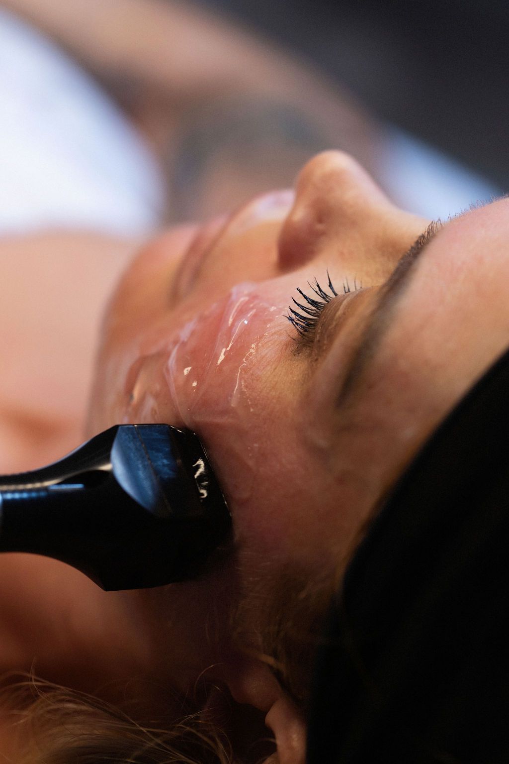 A person receiving a skin treatment on the cheek. A handheld device applies gel.