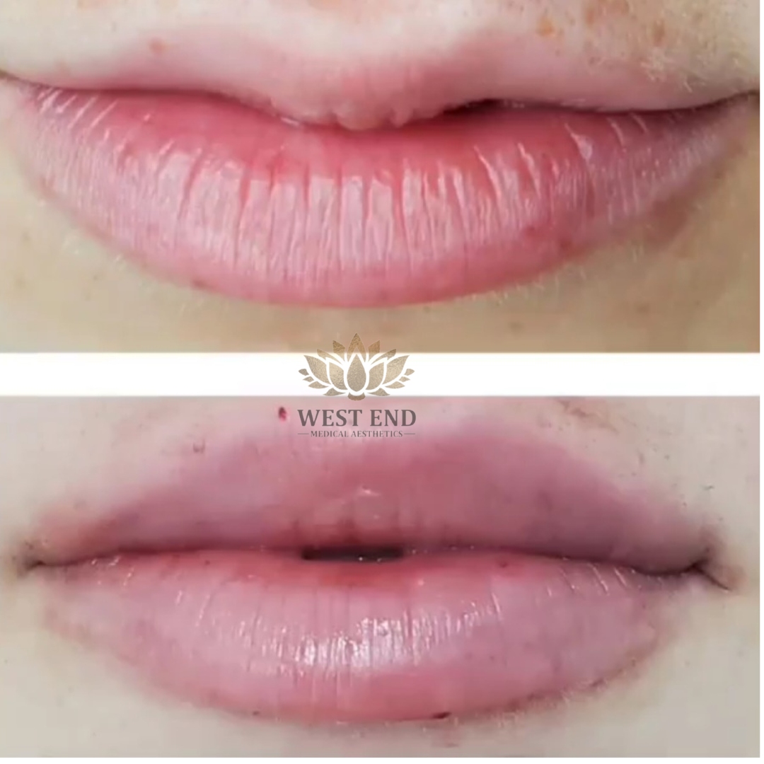 a before and after photo of a woman 's lips .