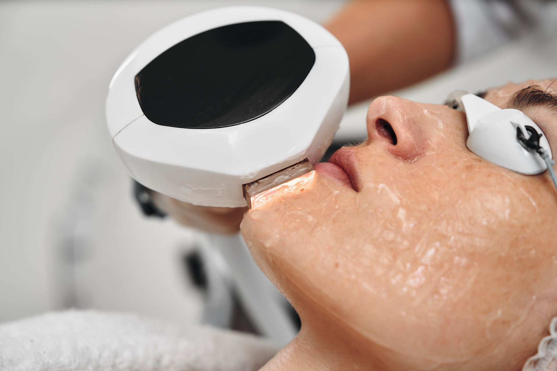 Person undergoing cosmetic laser treatment on their face with protective eyewear.