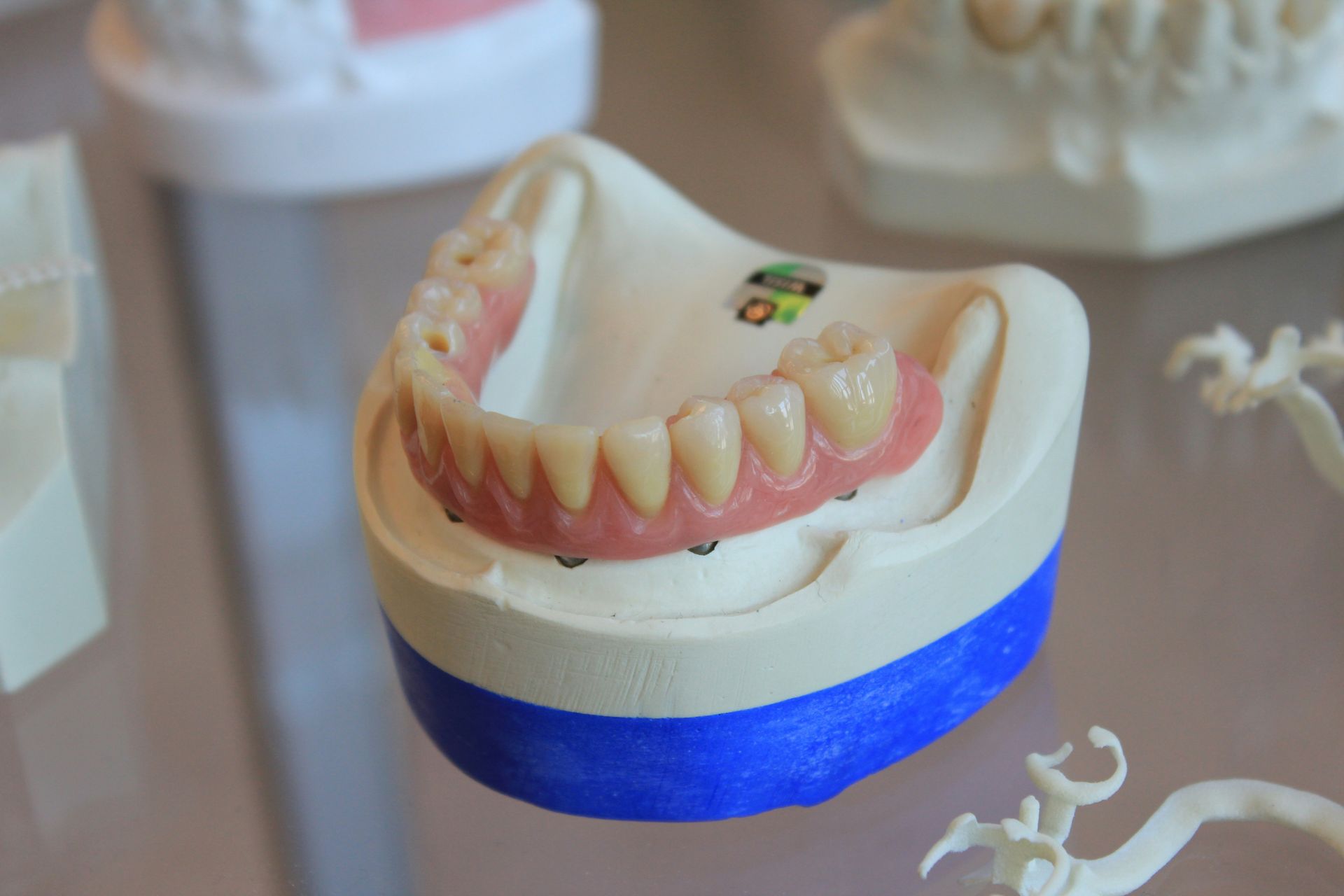 Implant denture model at Robert A. Lantzy DMD, Implant Restorations in Newtown, PA