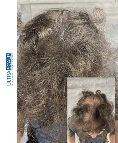 Scalp Micropigmentation For Long Hair (SMP)