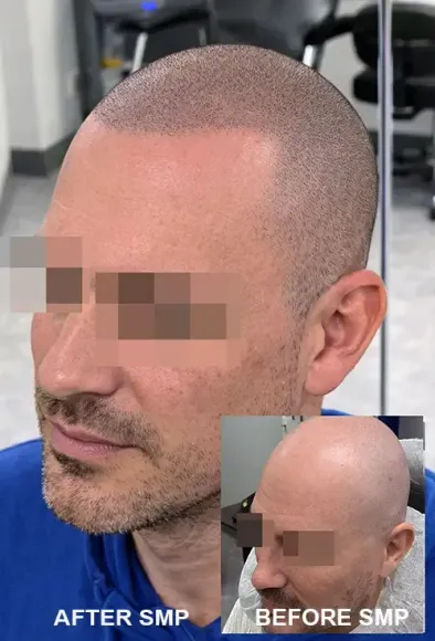 Scalp Micropigmentation Tampa
