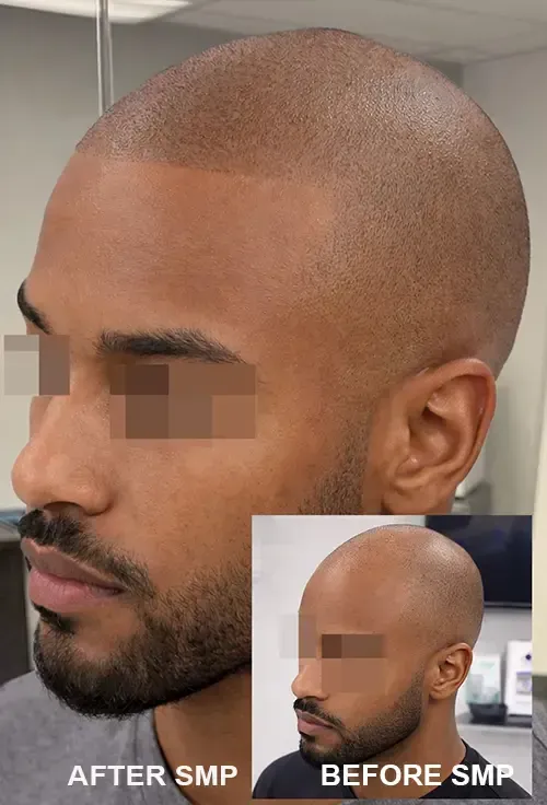 Scalp Micropigmentation Tampa