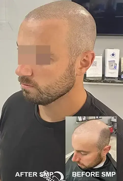 scalp micropigmentation thinning hair