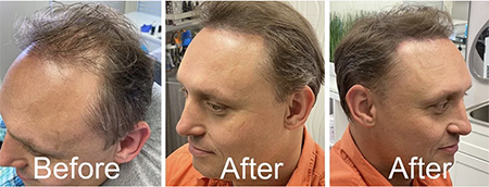 SMP After Hair Transplant Results Tampa