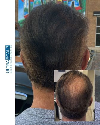 scalp micropigmentation for females with hair loss