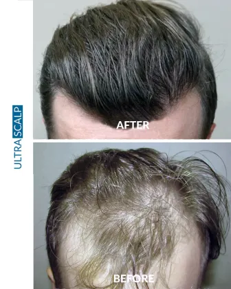 FUE Hair Transplant with SMP