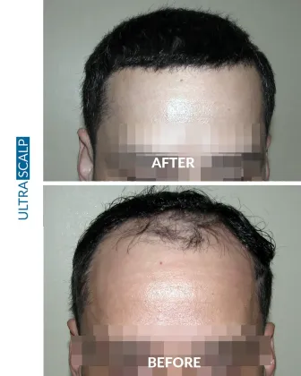 scalp micropigmentation with FUE Hair Transplant before and after