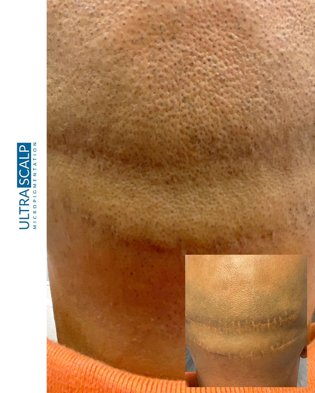 Hair Transplant Scar Cover Up 1