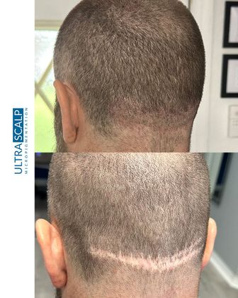 scalp micropigmentation after hair transplant Tampa