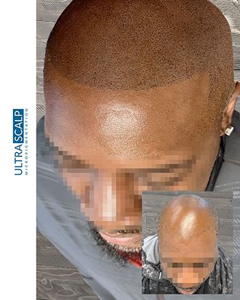 scalp micropigmentation after hair transplant Tampa