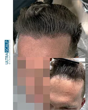 Scalp Micropigmentation For Thin Hairline Before And After (Actual Client)