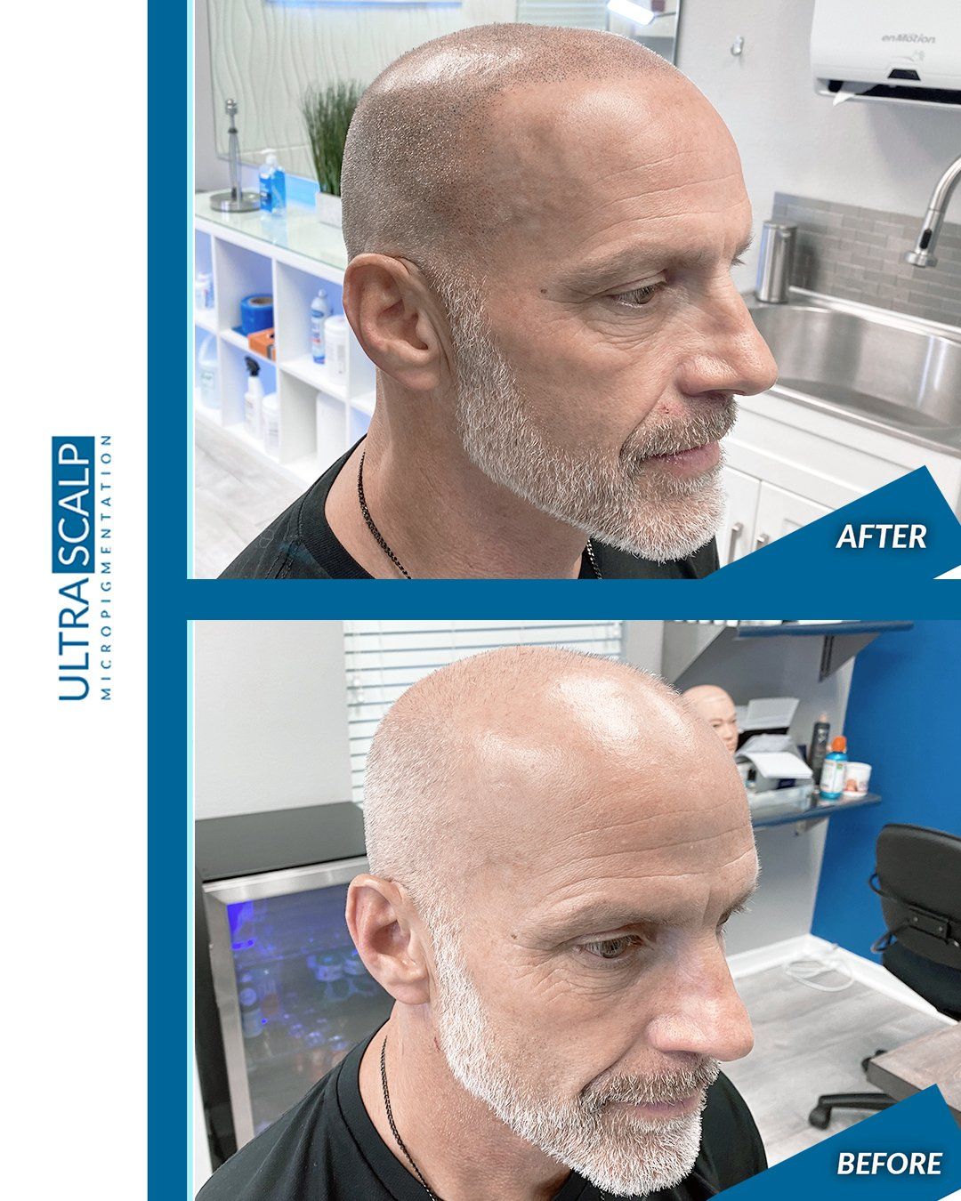 Scalp Micropigmentation On Gray Hair