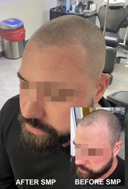 How much is scalp micropigmentation Tampa - Financing SMP Tampa 