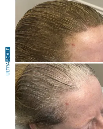 Scalp Micropigmentation and FUE Hair Transplant before and after female