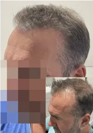 Scalp Micropigmentation Near Me