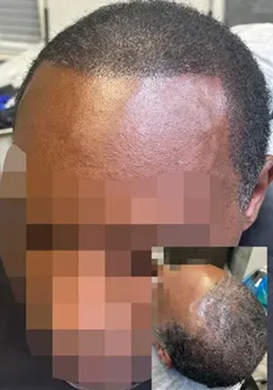 scalp micropigmentation Density tampa