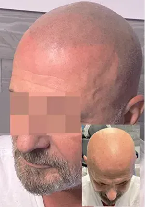 Scalp Micropigmentation For Male Pattern Baldness Tampa