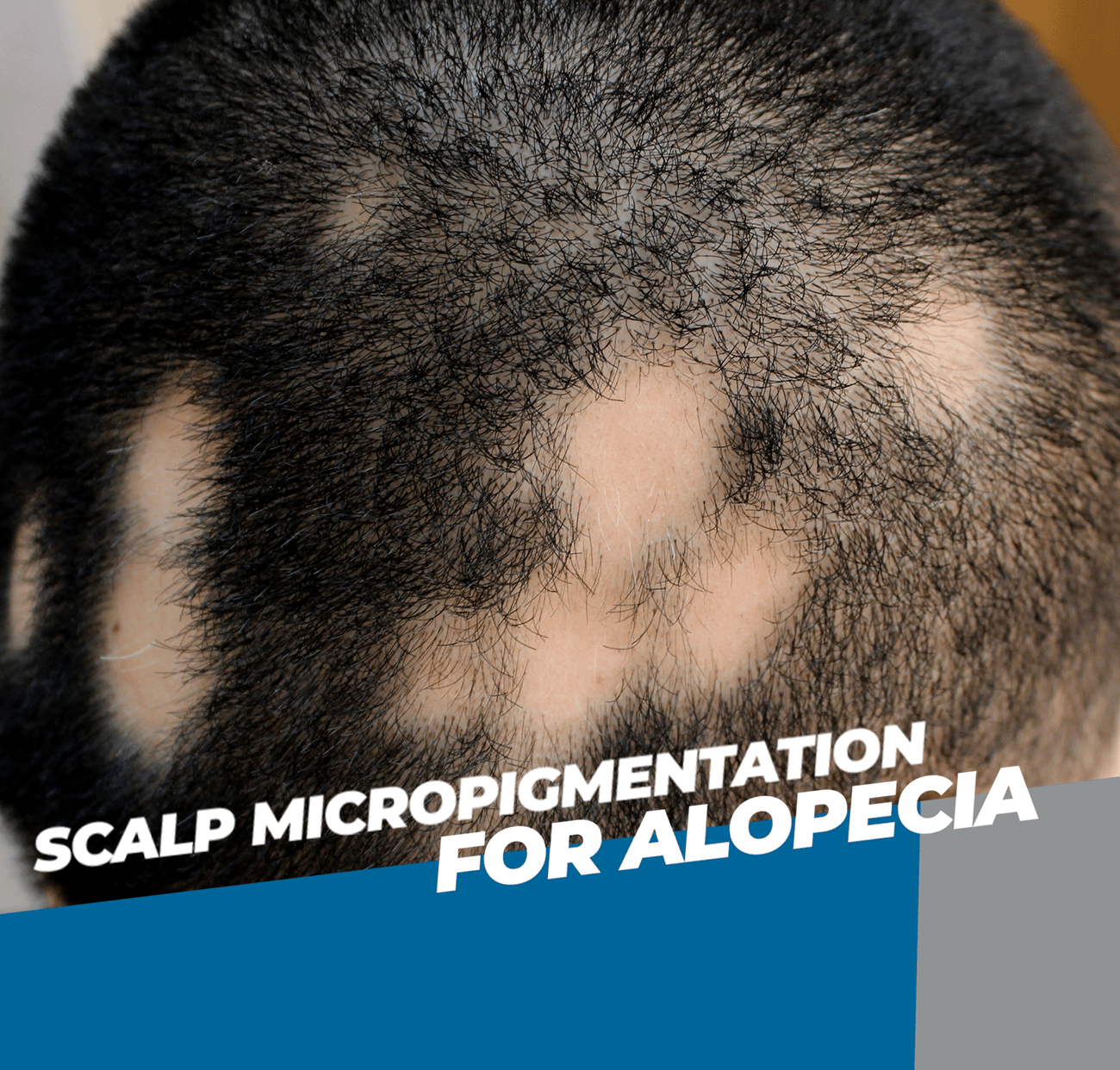 scalp mircopigmentation for alopecia