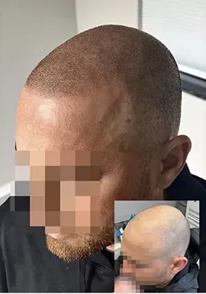 Scalp Micropigmentation Tampa