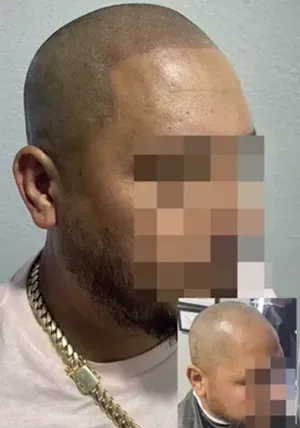 scalp micropigmentation for fixing hairline Shaved head look