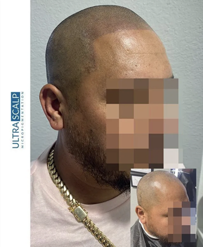 scalp micropigmentation for fixing hairline Shaved head look