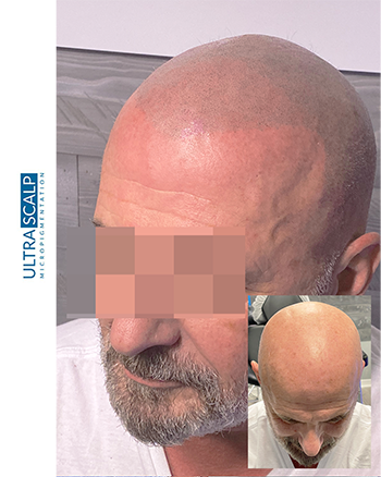 Scalp Micropigmentation For Male Pattern Baldness Tampa