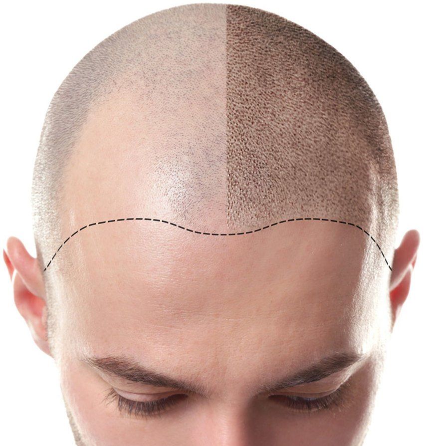 Scalp Micropigmentation for Hair Loss