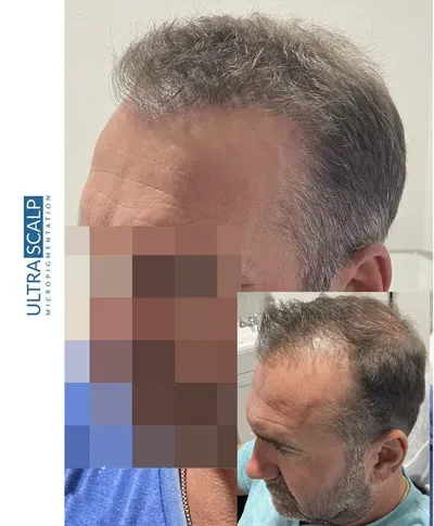 Scalp Micropigmentation Near Me