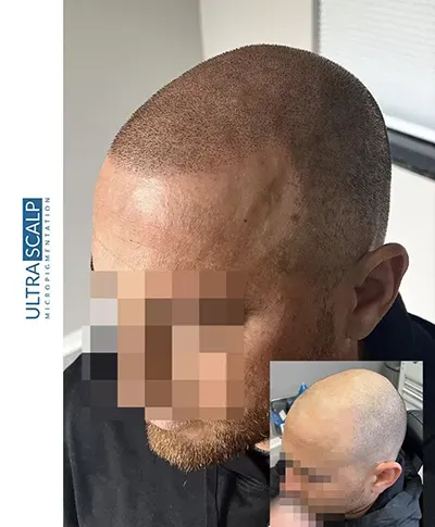 Scalp Micropigmentation Tampa