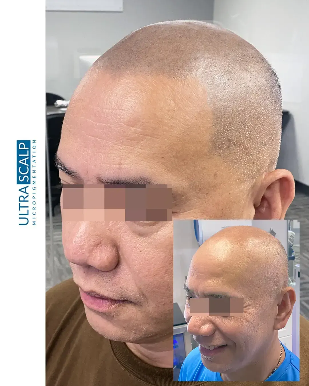 Scalp Micropigmentation Tampa