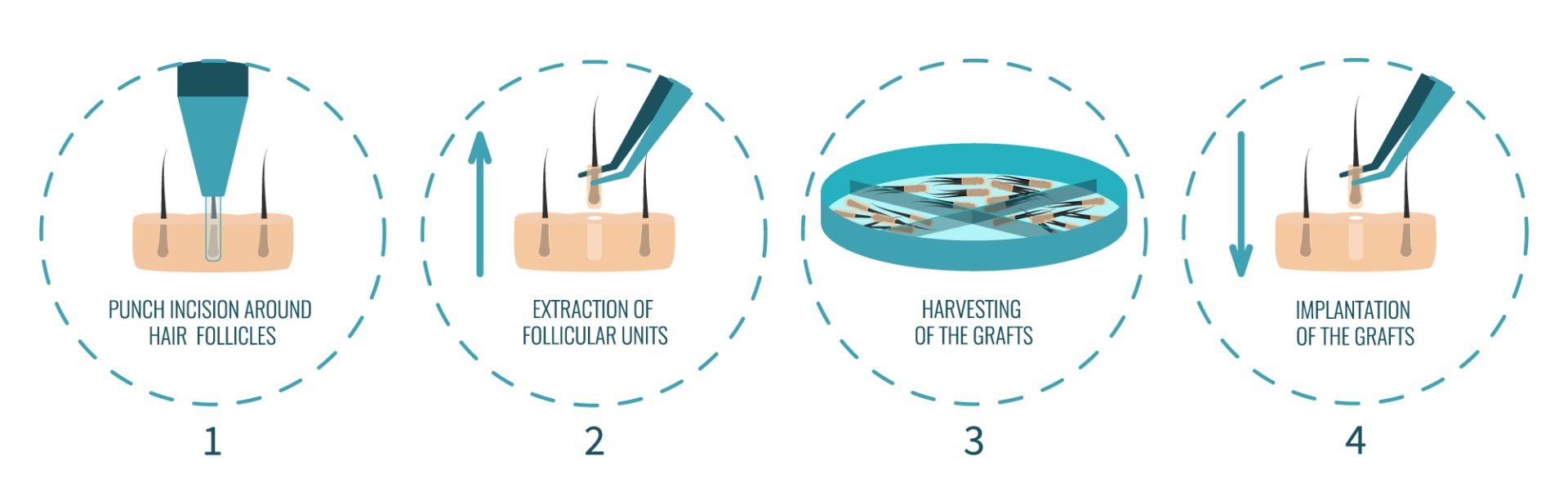 FUE transplant process